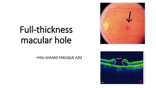 macular hole .pptx prensnter from Bangladesh | PPTX