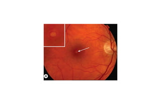 macular hole .pptx prensnter from Bangladesh | PPTX