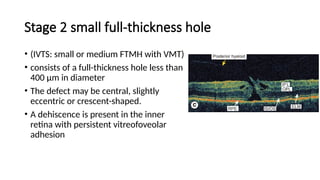 macular hole .pptx prensnter from Bangladesh | PPTX