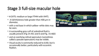 macular hole .pptx prensnter from Bangladesh | PPTX