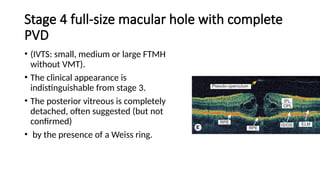 macular hole .pptx prensnter from Bangladesh | PPTX