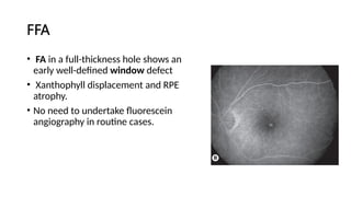 Window Defect Ffa Hyper macular hole .pptx prensnter from Bangladesh | PPTX