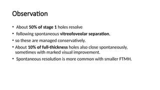 macular hole .pptx prensnter from Bangladesh | PPTX