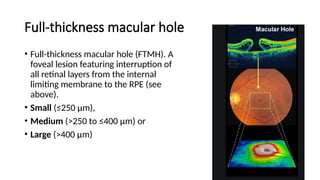 macular hole .pptx prensnter from Bangladesh | PPTX