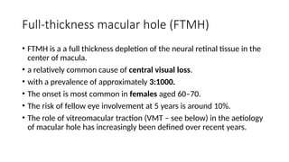 macular hole .pptx prensnter from Bangladesh | PPTX