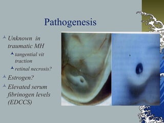 Pathogenesis
 Unknown in
traumatic MH
 tangential vit
traction
 retinal necrosis?

 Estrogen?
 Elevated serum
fibrinogen levels
(EDCCS)

 