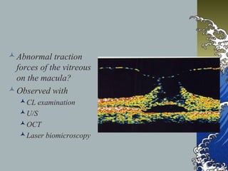  Abnormal traction
forces of the vitreous
on the macula?
 Observed with
 CL examination
 U/S
 OCT
 Laser biomicroscopy

 