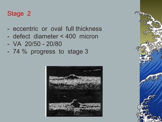 Stage 2
-

eccentric or oval full thickness
defect diameter < 400 micron
VA 20/50 - 20/80
74 % progress to stage 3

 