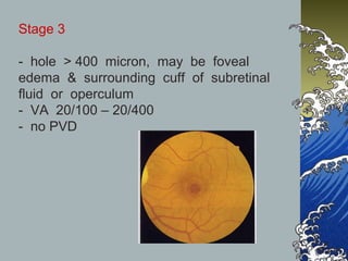 Stage 3
- hole > 400 micron, may be foveal
edema & surrounding cuff of subretinal
fluid or operculum
- VA 20/100 – 20/400
- no PVD

 