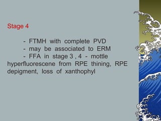 Stage 4
- FTMH with complete PVD
- may be associated to ERM
- FFA in stage 3 , 4 - mottle
hyperfluorescene from RPE thining, RPE
depigment, loss of xanthophyl

 