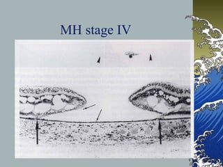 MH stage IV

 