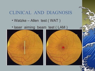 CLINICAL AND DIAGNOSIS
• Watzke – Allen test ( WAT )
• laser aiming beam test ( LAM )

 