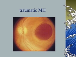 traumatic MH

 