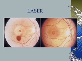 LASER

 