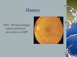 History
1869 : Herman Knapp :
initial published
description of MH

 