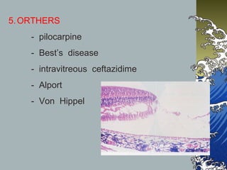 5. ORTHERS
- pilocarpine
- Best’s disease
- intravitreous ceftazidime
- Alport
- Von Hippel

 