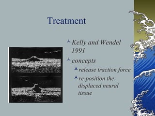 Treatment
Kelly and Wendel
1991
concepts
release traction force
re-position the
displaced neural
tissue

 