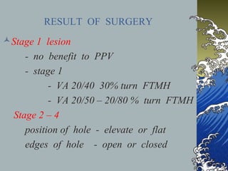RESULT OF SURGERY
Stage 1 lesion
- no benefit to PPV
- stage 1
- VA 20/40 30% turn FTMH
- VA 20/50 – 20/80 % turn FTMH
Stage 2 – 4
position of hole - elevate or flat
edges of hole - open or closed

 