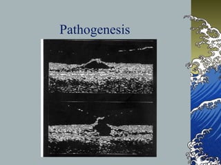 Pathogenesis

 