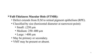 Macular Hole Surgery - Dr. Prabhat Devkota | PPTX