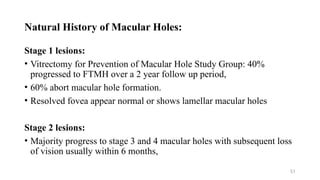 Macular Hole Surgery - Dr. Prabhat Devkota | PPTX