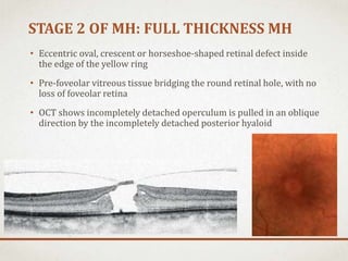 Operculated Shape Macular hole | PPTX
