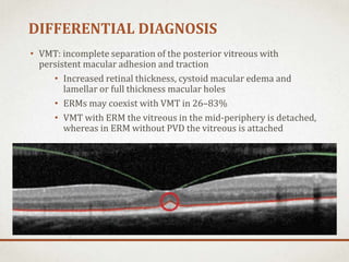 Vmt In Retina Macular hole | PPTX