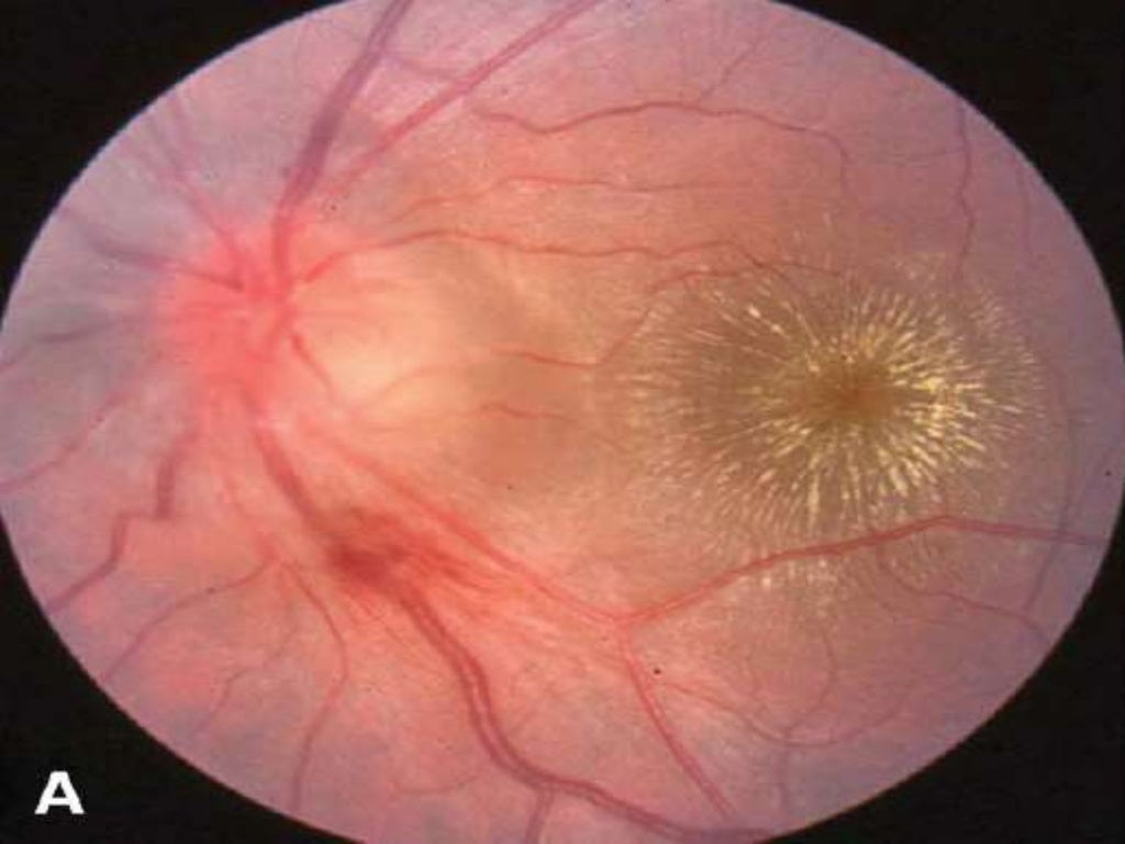 Macular star