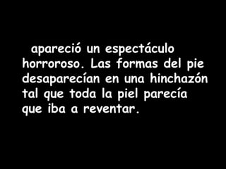 apareció un espectáculo 
horroroso. Las formas del pie 
desaparecían en una hinchazón 
tal que toda la piel parecía 
que iba a reventar. 
 