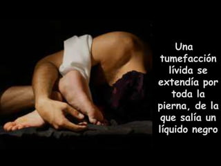 Una 
tumefacción 
lívida se 
extendía por 
toda la 
pierna, de la 
que salía un 
líquido negro 
 