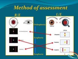 Orthophoria
Esophoria
Exophoria
Method of assessment
R/E L/E
IIEI&H
 