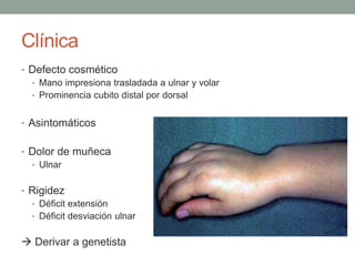 Clínica
• Defecto cosmético
• Mano impresiona trasladada a ulnar y volar
• Prominencia cubito distal por dorsal
• Asintomáticos
• Dolor de muñeca
• Ulnar
• Rigidez
• Déficit extensión
• Déficit desviación ulnar
 Derivar a genetista
 