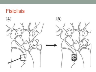 Fisiolisis
 