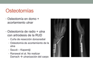 Osteotomías
• Osteotomía en domo +
acortamiento ulnar
• Osteotomía de radio + ulna
con artrodesis de la RUD
• Cuña de resección dorsoradial
• Osteotomía de acortamiento de la
ulna
• Sauvé – Kapandji
• Ranawat et al. No realizar
Darrach  ulnarización del carpo
 