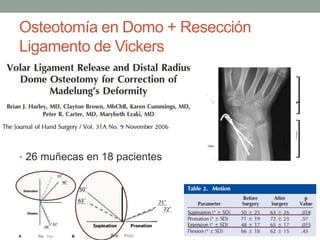 Osteotomía en Domo + Resección
Ligamento de Vickers
• 26 muñecas en 18 pacientes
 