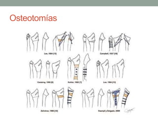Osteotomías
 