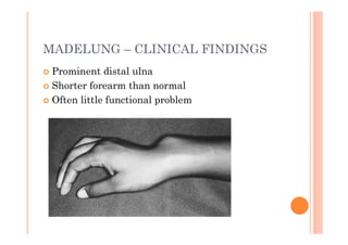 MADELUNG – CLINICAL FINDINGS
 Prominent distal ulna
 Shorter forearm than normal
 Often little functional problem
 