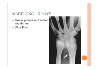 MADELUNG – X RAYS
 Excess palmar and radial
 angulation
 Ulna Plus
 