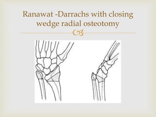 
Ranawat -Darrachs with closing
wedge radial osteotomy
 