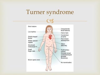 
Turner syndrome
 