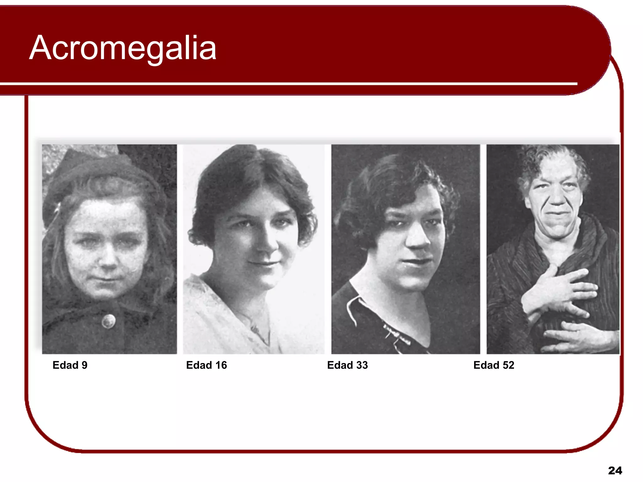 Acromegalia




 Edad 9   Edad 16   Edad 33   Edad 52




                                        24
 