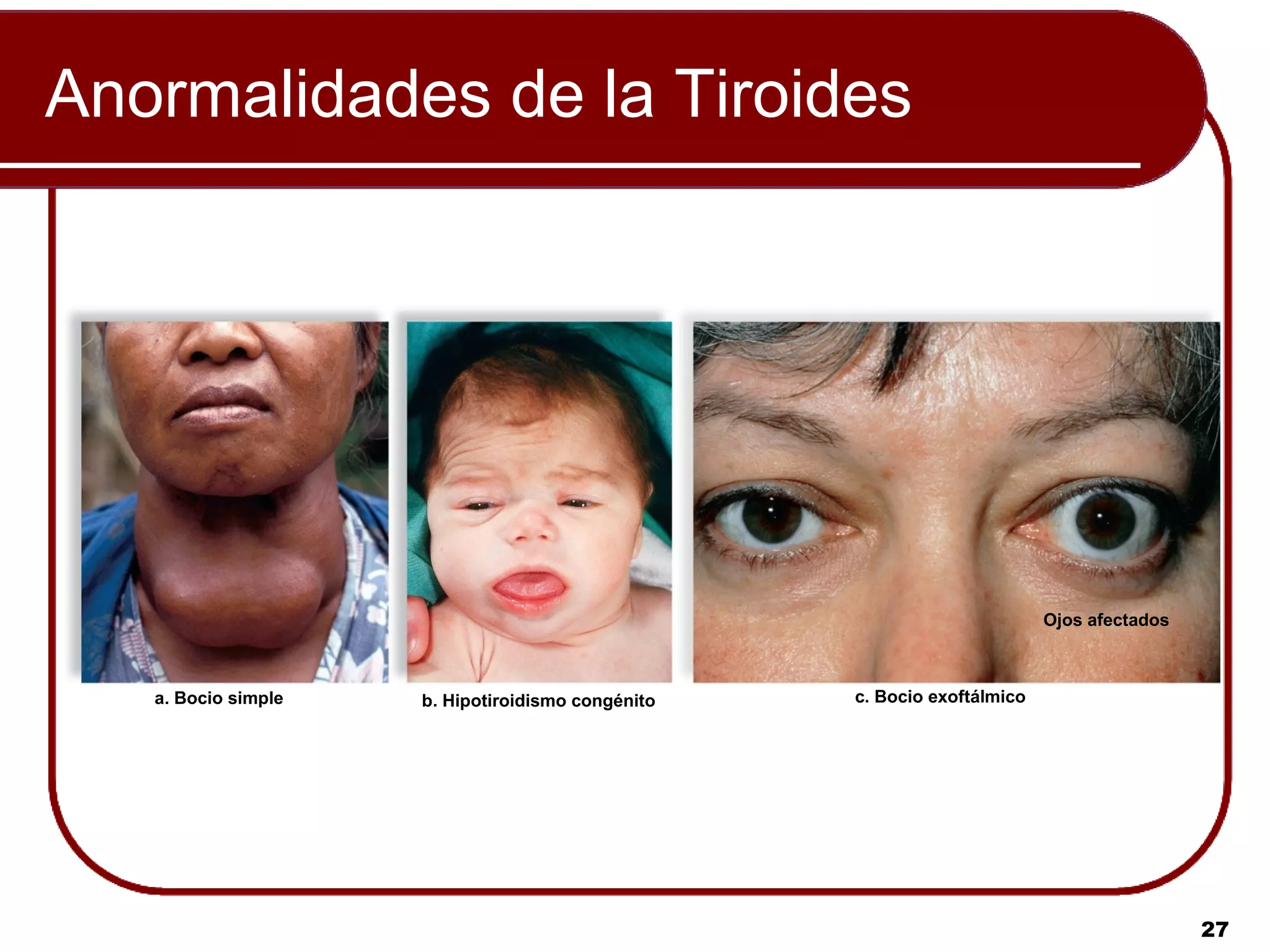 Anormalidades de la Tiroides




                                                                          Ojos afectados



   a. Bocio simple   b. Hipotiroidismo congénito   c. Bocio exoftálmico




                                                                                           27
 