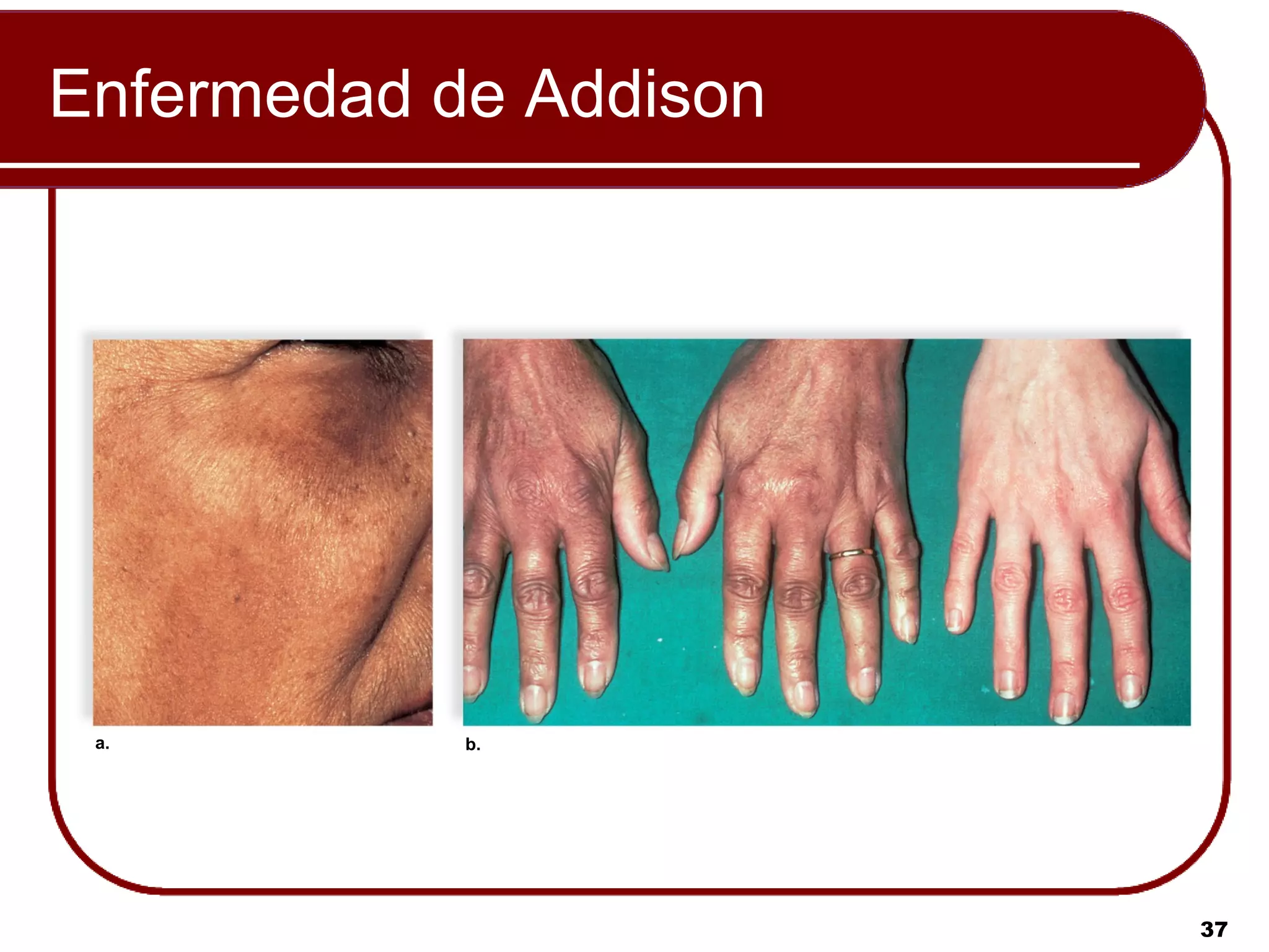 Enfermedad de Addison




 a.         b.




                        37
 