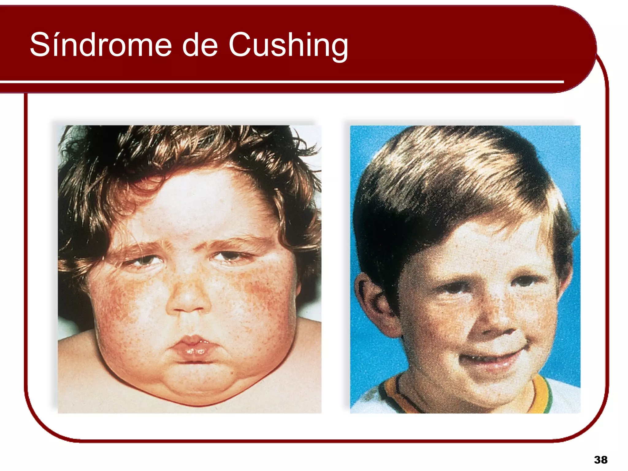 Síndrome de Cushing




                      38
 