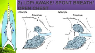 2) LDP/ AWAKE/ SPONT BREATH/
OPEN CHEST
 