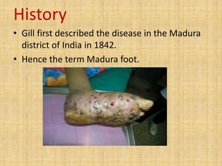 History
• Gill first described the disease in the Madura
district of India in 1842.
• Hence the term Madura foot.
 