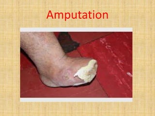 Amputation
 