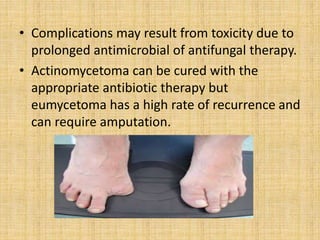 • Complications may result from toxicity due to
prolonged antimicrobial of antifungal therapy.
• Actinomycetoma can be cured with the
appropriate antibiotic therapy but
eumycetoma has a high rate of recurrence and
can require amputation.
 
