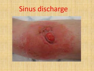 Sinus discharge
 