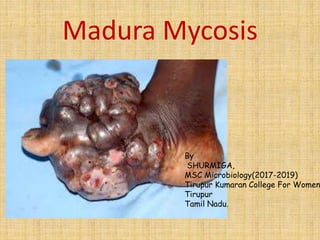 Madura Mycosis
By
SHURMIGA,
MSC Microbiology(2017-2019)
Tirupur Kumaran College For Women
Tirupur
Tamil Nadu.
 
